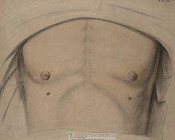 Drawing of a man with supernumerary nipples