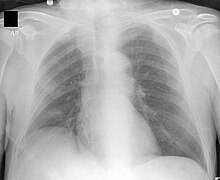 Radiografía de tórax en un paciente con enfermedad de Niemann Pick