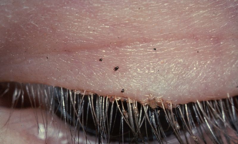File:Pubic lice on eye-lashes.jpg