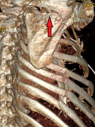 <span class="mw-page-title-main">Scapular fracture</span> Injury of the shoulder blade