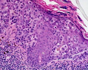 Skin Tumors-479.jpg 