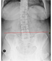 Small Lumbar Scoliosis Curve with Pelvic Torque.png