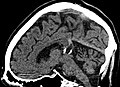Verkalkte Pinealiszyste desselben Falls, hier dargestellt auf einem Schnittbild in sagittaler Rekonstruktion (CT)