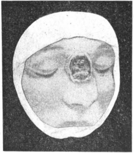 Венеричні хвороби та як від них уберегтися. Виразка носа в занедбаному третинному періоді сифілісу. 1930.png