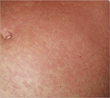 Typical fine-spotted pink rash of acute African trypanosomiasis on the skin of the abdomen (”trypanid rash”)[15]