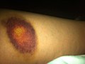 Bruise Hematoma from abuse of spouse.jpg