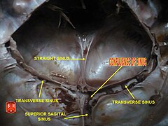 confluence of sinuses skull