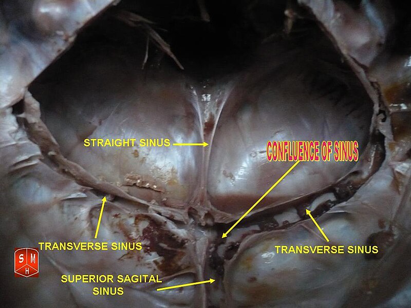 File:Confluence of sinuses.jpg