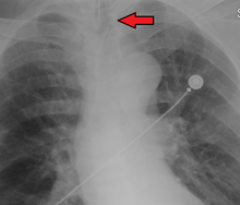 An endotracheal tube not deep enough. Arrow marks the tip. ETtubeToHigh.png