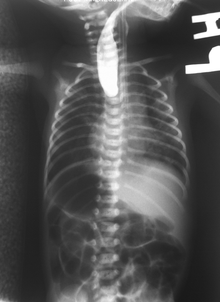 Plain x-ray with contrast in the upper esophagus above the atresia. Esophageal atresia contrast.png