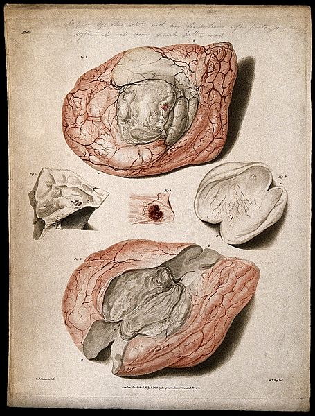 File:Five sections of diseased brain. Colour stipple etching by W Wellcome V0009773EL.jpg