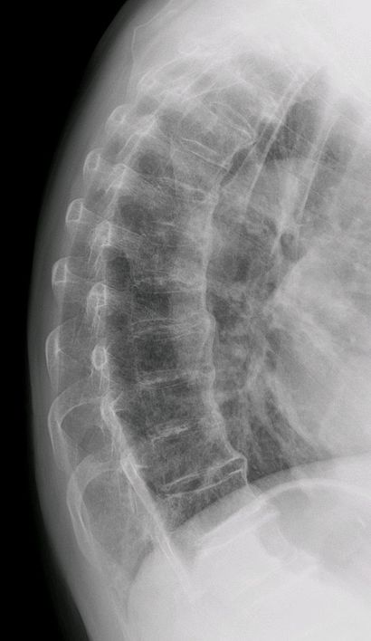 Forestier's disease, X-ray of thoracic column.jpg