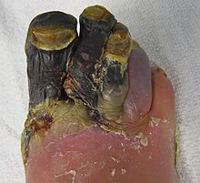 Gangrene of three toes resulting from peripheral artery disease GangreneFoot.JPG