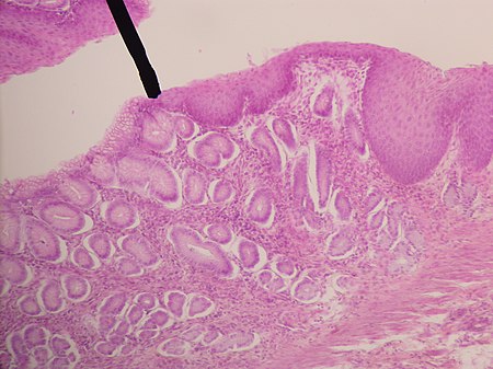 ไฟล์:Gastro-esophageal_jxn.JPG