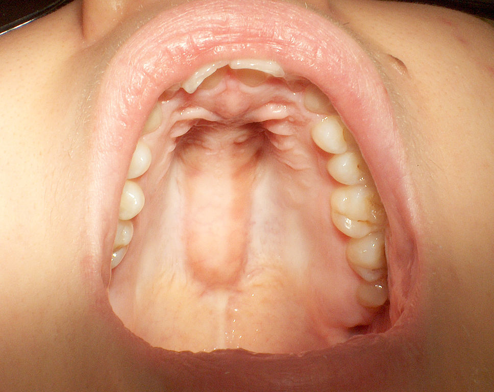 Bone Growths In Mouth 10