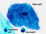 Miniatuur voor Bestand:Micrograph of a clue cell, annotated.jpg