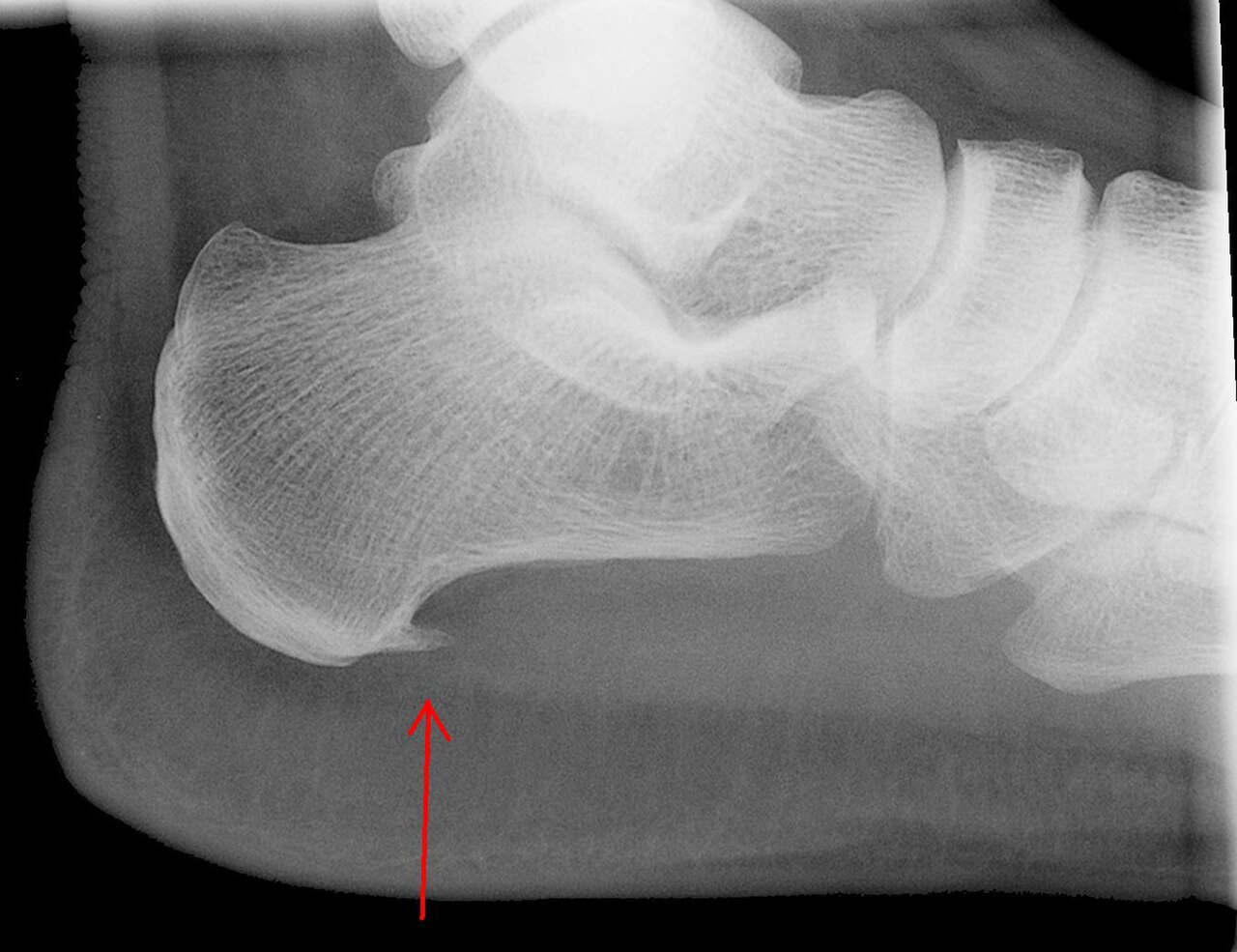 calcaneal spur xray