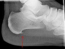 Heel bone with heel spur (red arrow) Projectional radiography of calcaneal spur.jpg