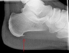 Projectional radiography of calcaneal spur.jpg