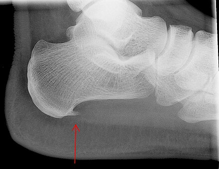 Heel bone with heel spur
