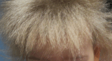 Scalp hair-uncombable hair syndrome.gif