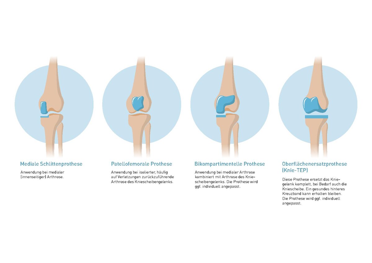 Datei:Schematische Darstellung von Knieprothesen-Typen.pdf – Wikipedia 