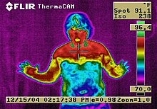Imagem termica de paciente após 2 anos de realização da simpatectomia.