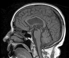 Een sagitale MRI afbeelding toont atrofie in het mesencephalon kenmerkend voor PSP.
