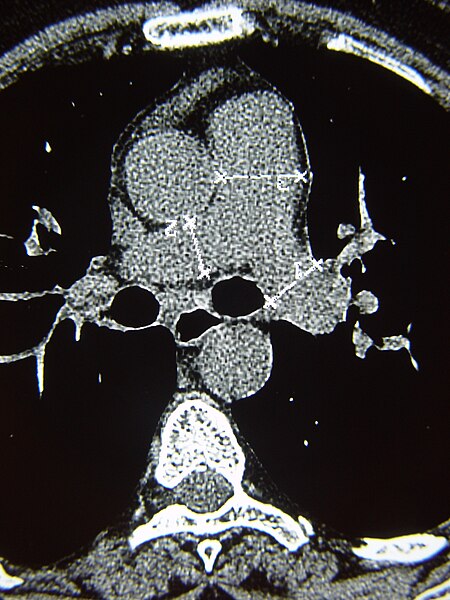 File:Systemic sclerosis case 11 pic 09.jpg