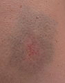 Bruise from bicycle accident.jpg