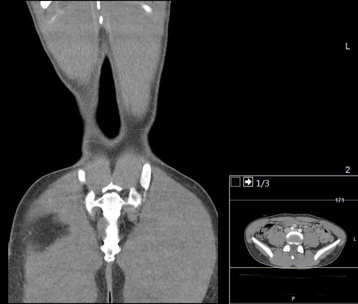 CT of a normal abdomen and pelvis, coronal plane 129.png