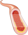 Atheroma 6