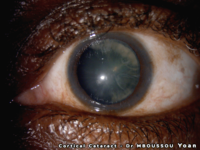 cortical cataract