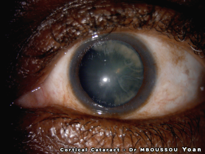 Cortical cataract of a melanoderm male