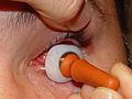 Colocación Protesis Ocular 1.jpg