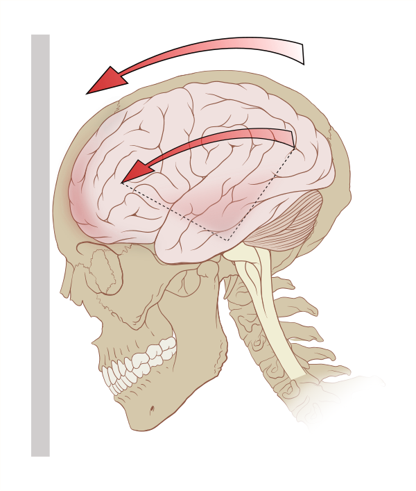 football-concussions-the-link-between-head-injuries-and-cte-explained