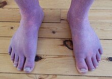 Dependent Acrocyanosis in a Norwegian 33-year old male POTS patient.jpg