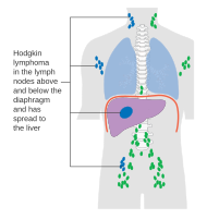 Stage 4 Hodgkin lymphoma