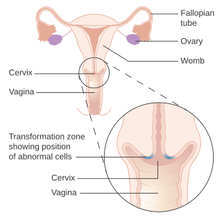 <span class="mw-page-title-main">Cervical screening</span> Type of medical screening