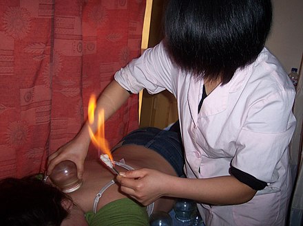 A person receiving fire cupping