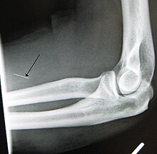 Fragment of hypodermic needle stuck inside arm of IV drug user (x-ray).jpg