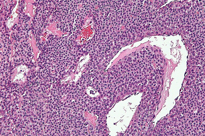 File:Glomus tumour - high mag.jpg