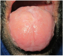 Macroglossia with crenations along the margins and loss of papillae on dorsum surface of the tongue.png