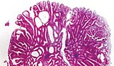 Micrograph of tubulovillous adenoma.jpg