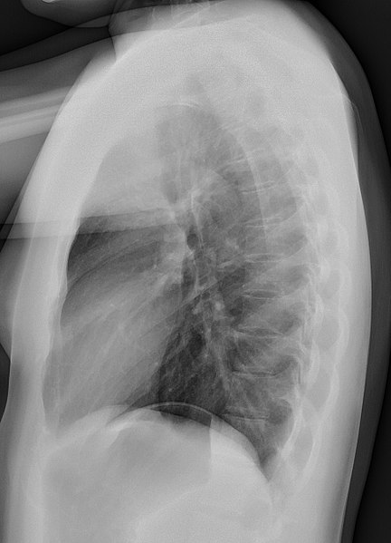 File:Normal lateral chest radiograph (X-ray).jpg