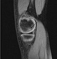 膝關節核磁共振（MRI）矢狀面影像：膝關節面的低T1權重影像，可以看到在股骨內髁（英语：Medial condyle of femur）外側有一個剝脫性骨軟骨炎病灶。
