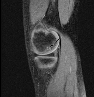 Sagittal MRI: Linear low T1 signal at the articular surfaces of the lateral aspects of the medial condyle of the femur confirms the presence of OCD.