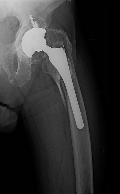 Periprosthetic fracture of left femur