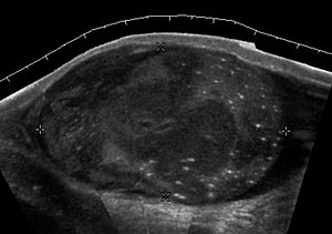 Scrotal Ultrasound