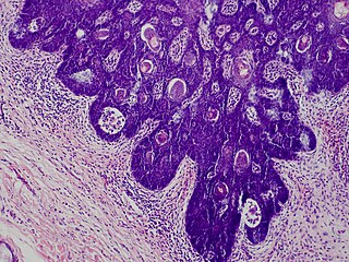 Folliculosebaceous cystic hamartoma